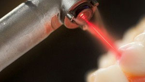 اقتراح لاستخدام الليزر في إعادة بناء الأسنان